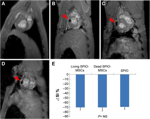 Figure 5 CMR imaging.Notes: (A) Representative in vivo CMR imaging of injected 5×105 unlabeled MSCs, (B) living SPIO-MSCs, (C) dead SPIO-MSCs, and (D) SPIO (0.6 μL Resovist) in swine heart. Red arrows in figures B–D indicate the signal void corresponding to the injection sites. (E) Quantitative analysis of signal intensity. ⊿SI=[(SI−SIunlabeled MSCs)/SIunlabeled MSCs]×100%.Abbreviations: CMR, cardiac magnetic resonance; LV, left ventricle; MSCs, mesenchymal stem cells; NS, not significant; RV, right ventricle; SPIO, superparamagnetic iron oxide; SPIO-MSCs, mesenchymal stem cells incubated with superparamagnetic iron oxide; SI, signal intensity.