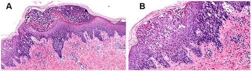 Figure 2 Epidermal hyperkeratosis and parakeratosis, neutrophil infiltration in the stratum corneum, abscess formation, irregular thickening of the spinous layer, spongiosis, and liquefaction degeneration in the basal layer. The epithelium extends inferiorly and is serrated. Lymphocytes infiltrate in the superficial dermis and around the skin adnexa (a, b) (magnification × 400).