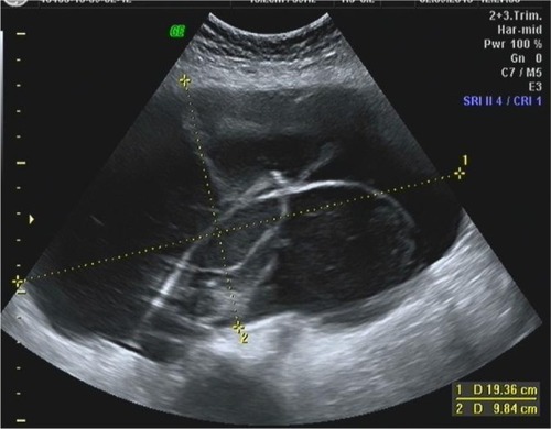 Figure 9 Transabdominal ultrasound scan in a 41-year-old woman.