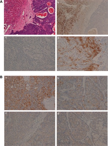Figure 3 Histopathology of the liver metastasis.