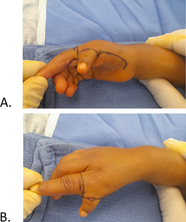 Figure 3 Skin design: (A) Palmar skin design; (B) Dorsal skin design.