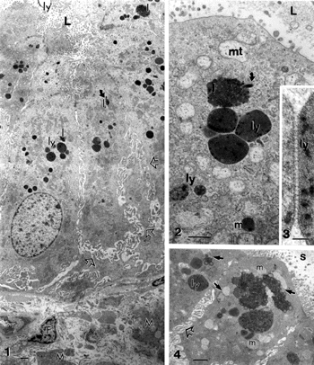 Figures 1–4 Gallbladder epithelium areas from a chronic cholecystitis. Cell crowding and subcellular alterations are blunted microvilli, exaggerated basal and basolateral spaces (open arrows). Apical electron-dense deposits include angulated lysosomes (ly; Figures 2 and 3), heterogenous lipids (l) with paracystalline deposits (curved arrows, in Figures 1 and 2), and altered mitochondria (mt) and fragmented endoplasmic reticulum (ER) in the subapical regions. A detailed view of an intelysosomal junction is illustrated in Figure 3. Apical regions of adjacent cholecytocytes show abundant mucous vesicles (m), heterogenous lipid bodies (l), lysosomes (ly), and muco-liposomes (arrow in Figure 4). The lumen (L) contains biliary sludge (s). Scale bars in Figures 1,2 and 4 equals 1 μm;, in Figure 3 the bar equals 100 nm.