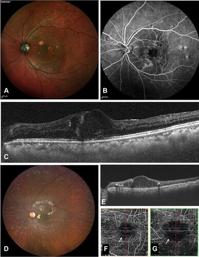 Figure 3 A 49-year old male presented with decreased vision in his left eye 3 years after treatment with external beam radiotherapy for orbital lymphoma. His visual acuity at presentation was 20/100. Fundus examination (A) showed few hemorrhages over macula with clinically evident macular edema . Fundus fluorescein angiography (B) demonstrated multiple microaneurysms and leaking capillaries with enlarged, irregular foveal avascular zone (FAZ) . Optical coherence tomography (OCT) showed center involving macular edema (C). The patient received multiple anti-VEGF injections. At the end of 12 months follow-up, vision was maintained at 20/125. Fundus examination at 12 months visit showed a few hard exudates and few hemorrhages over macula (D). OCT (E) at this visit showed a chronic refractory macular edema and an increase in FAZ size could be seen demonstrated on OCT angiography in both superficial (F) and deep capillary (G) slab.