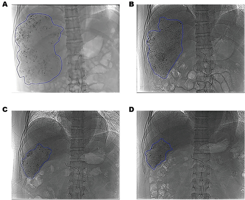 Figure 3 Tumor lipiodol deposition angiography image. The area of Lipiodol deposition decreased from 2720mm measured after the first conversion treatment (depicted by the blue line) to 5289mm after the fourth conversion treatment. (A) the first time 2021-06-21; (B) the second time 2021-07-22; (C) the third time 2021-09-10; (D) Fourth 2021-10-28.