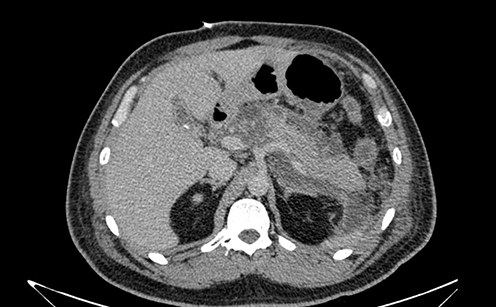 Figure 1 The CT showed diffuse edema of the pancreas, accompanied by peripancreatic fluid collection and gallstones.