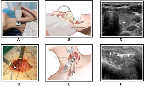 Figure 1 Ultrasound visualization of the recurrent laryngeal nerve (RLN), preoperative (A–C) and intraoperative (D–F).