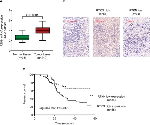 Figure 1 Upregulated RTKN expression correlated with poor prognosis of GC patients.Notes: (A) RTKN expression was significantly increased in GC tissues when compared with the normal tissues based on TCGA-STAD-exp-HiSeq. (B) IHC analysis of RTKN protein expression in GC tissues and adjacent normal tissues. Magnification: 200×. (C) The overall survival analysis of 89 patients with GC.Abbreviations: GC, gastric cancer; IHC, immunohistochemistry; TCGA, The Cancer Genome Atlas.