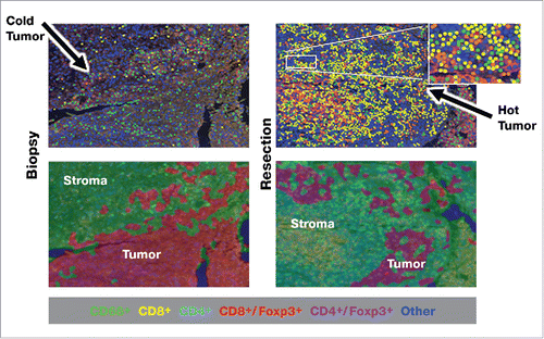 Figure 1. Multiplex IHC showing relationships of immune infiltrating cells to each other and increases after treatment with IRX-2.