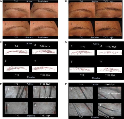 Figure 3 Effect of eyebrow gel on (A–D) eyebrow growth and (E, F) thickness.