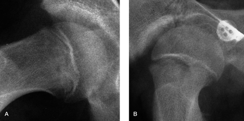 Figure 1. A. The right hip of a 13-year-old boy, showing a large epiphyseal tubercle. B. This is contrasted with the right hip of a 12-year-old boy, showing a fairly small epiphyseal tubercle, which nevertheless still has a stabilizing effect on the developing SUFE.