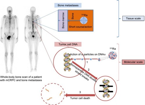 Figure 1 223Ra mechanism of action in bone metastases.Abbreviations: 233Ra, radium-223; mCRPC, metastatic castration-resistant prostate cancer.