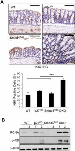 Figure 3. Proliferation of mucosal epithelial cells is increased in the colon of DKO mice. A) Immunohistochemistry (IHC) analysis for Ki-67 in the colon of WT, p27KO, Smad4TKO and DKO mice. The percentage of Ki-67 positive cells among all colon epithelial cells was determined in the colon at 3 months of age using a digital eyepiece. Data represent average ± S.E. (n = 4). B) Expression of PCNA and, p-Rb, and β-actin was measured by Western blot. Results shown are representative of 3 separate experiments. ***P < .001. Scale bar = 100 µm