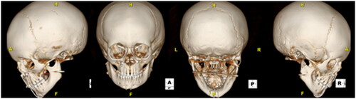 Figure 3. The immediate post-operative CT maxillofacial scan revealed anatomic reduction of the fracture Sites.