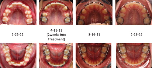 Figure 1. Completion of alignment, levelling and space closure with fixed appliances following premolar extractions. The treatment time for completion of these stages was 10 months. Photo-biomodulation was applied to the patient 20 minutes every day