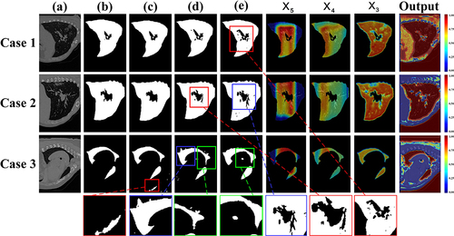Figure 9 To explore the role of attentional mechanisms on COVID-19 CT Dataset. Where F3 represents layer 3, F4 represents layer 4, F5 represents layer 5. (a) Origin, (b) Ground Truth, (c) MS-DCANet, (d) SmaAt-UNet, (e) Attention U-Net.
