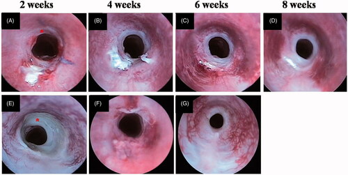 Figure 9. Bronchoscopic images. The asterisk indicates the implanted scaffolds. A–D. PCL-OC group. E–G. PCL group. PCL: polycaprolactone scaffold group, PCL-OC: PCL scaffold cultured in omentum for 2 weeks before transplantation group.