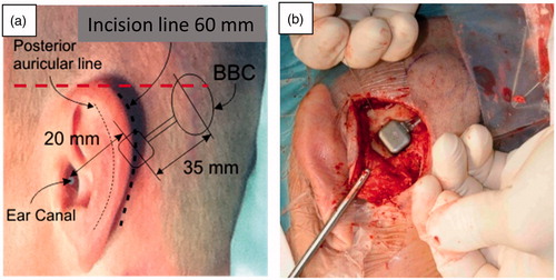 Figure 3. Positioning of the Bridging Bone Conductor (BBC) behind the ear (a) and the transducer in a prepared recess secured by a titanium wire. (b) The transducer casing in patient 1 was secured by a flexible titanium plate with screws at the ends, whereas in patient 2–16 it was secured by a thin titanium wire.