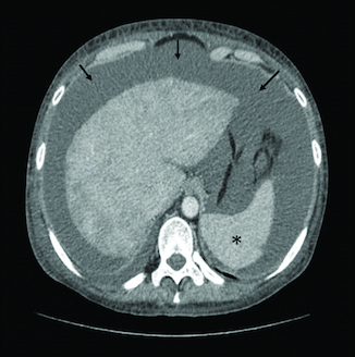 Figure 1. Liver dysmorphia and signs of portal hypertension (splenomegaly [asterisk] and ascites [arrow]) on abdominal CT scan.
