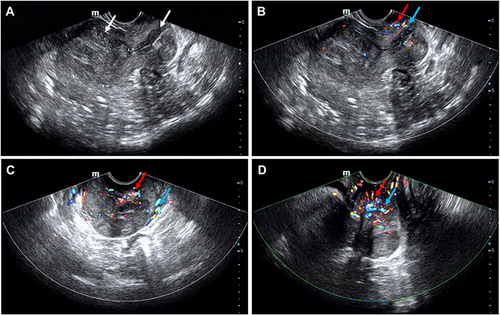 Figure 1 The locations of the tumor on transvaginal ultrasound apparatus (A, white arrows) and Color Doppler flow imaging (CDFI) results (B–D), red and light blue arrows).