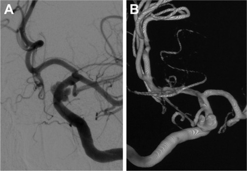 Figure 1 Head DSA images showing left internal carotid artery aneurysm in the supraclinoid segment.