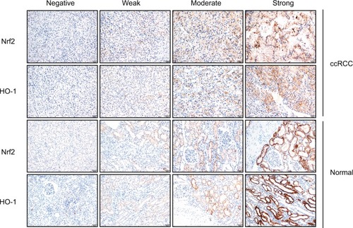 Figure 2 Nrf2 and HO-1 were expressed both in ccRCC and adjacent normal tissues. Expression scoring was performed as follows: the staining of tumors was quantitated by determining the percentage of positive cells and the staining intensity (Scale bar, 50µm).Notes: The intensity of cell staining was categorized as follows: 0, negative staining; 1, weak staining; 2, moderate staining; and 3, strong staining. The extent scores (percentages of cells stained positive) were as follows: 0, no positive cells; 1, positive cells staining <10%; 2, 11%–30% of cells; 3, 31%–60%; 4, 61%–90% of cells; and 5, the percentage of positive cells staining >90%. The final staining score was calculated by adding the points from the positive cell percentage and the staining intensity. A score of 0 points was considered negative expression (–), 1–3 points were considered weakly positive expression (+), 4–6 points were considered moderately positive expression (++), and 7–8 points were considered strongly positive expression (+++).Abbreviation: ccRCC, clear cell renal cell carcinoma.