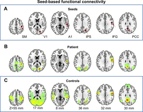 Figure 2 Seed-based functional connectivity. (A) Schematic of seed region selection, these 6-mm-diameter spherical regions include the right primary SM, A1, V1, IPS, IFG, and PCC, whose functional roles are involved in the somatomotor, auditory, visual, dorsal attention, language, and default systems, respectively. (B) The topographies where time courses in the patient’s seed region is positively correlated (r=0.5) with other voxels in the whole brain, which are large-scale brain network systems including the somatomotor, auditory, visual, dorsal attention, language, and default systems; visually, these networks show prominent reductions in the contralateral functional connectivity corresponding to the seed regions (ie, ipsilateral functional connectivity). (C) Group average functional connectivity maps (correlation maps) of the healthy controls, the topographies where time courses in the seed region is positively correlated (r=0.5) with other voxels in the whole brain, outlines typical large-scale brain networks, as previous described and reported.