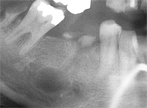 Figure 1 Radiograph of right mandibular second premolar showing gross caries and periapical radiolucency.