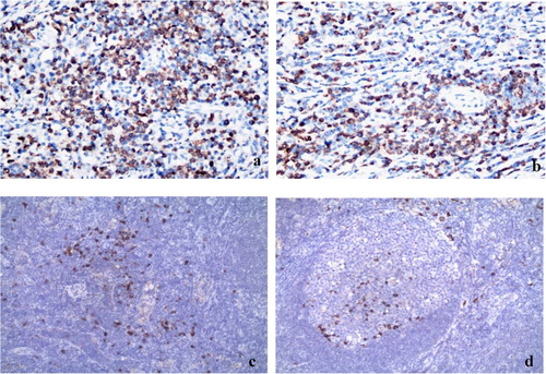 Figure 1. The expression of mIgD and IgDR from DLBCL tissues and reactive hyperplasia of lymph nodes. Tissue samples were analyzed using IHC and a Image-pro Plus Image analysis and management system (×100). a. The expression of mIgD from DLBCL tissues. b. The expression of IgDR from DLBCL tissues. c. The expression of mIgD from reactive hyperplasia of lymph nodes. d. The expression of IgDR from reactive hyperplasia of lymph nodes.