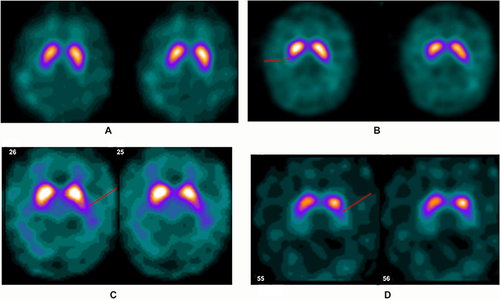 Figure 1 DaTscan SPECT images of four separate patients. Image (A) demonstrates the normal “comma” configuration on the striata bilaterally, which would receive a score of 0. The progressive loss of dopamine transporters would then be classified as mild on the right (arrow) on image (B) score of 1, moderate on the left (arrow) on image (C) score of 2 and severe on the left (arrow) on image (D) score of 3.