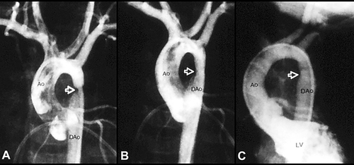 Figure 6 Selected aortic (Ao) and left ventricular (LV) cine-angiographic frames of a one-month-old baby prior to (A), immediately after (B) and 1 year following (C) balloon angioplasty are shown. The coarcted aortic segment (arrowhead) shown in “A” improved remarkably after angioplasty (B) which continues to be wide open at follow-up (C). Reproduced from Rao PS. Coarctation of the aorta. In: Secondary Forms of Hypertension, Ram CVS (Ed), Seminars in Nephrology, Kurtzman NA (Ed), (W)B. Saunders, Philadelphia, PA. Seminars in Nephrology. 1995;15(2):81–105.Citation1