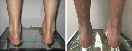 Figure 2. (Left) Preoperative picture of a 9-year-old child standing, seen from the back. The lines drawn show the presence of a heel varus deformity of the hindfoot. (Right) Same child in a similar position, 18 months after surgery. Note the changes in the heel position, now in a valgus position.