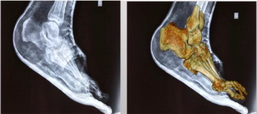 Figure 3. X-ray after surgery to relieve plantar pressure by cutting cuboid bone prominence.