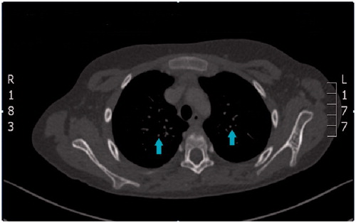 FIGURE 1. Multiple small nodules, less than 0.5 cm (arrows pointing to the lesions) are seen scattered throughout both lung fields associated with scattered focal fibrosis and pleural thickening.