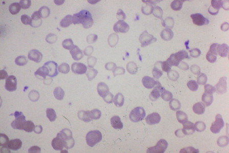 Figure 1. Peripheral blood smear from a patient with IDA. Characteristic microcytic/hypochromic red cells noted in the center of the field.