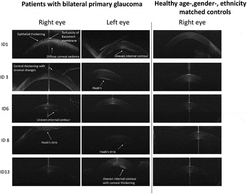 Figure 2. Corneal horizontal HH-OCT images of patients with PCG and healthy age-, gender- and ethnicity-matched controls. Patients with PCG showed a variety of changes, including epithelial thickening with a tortuous contour of the Bowman membrane (ID1, 6 and 13), uneven internal contour and the presence of Haab’s striae (ID3, 8). Reprinted with permission from [Citation61], licensed under https://creativecommons.org/licenses/by/4.0/.