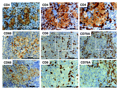 Figure 3. Human immune cell co-localization in the spleen of HTM. Histological staining for CD4 expression in the spleen of BT474 transplanted HTM presented in different magnification (top row). Further staining for macrophages (CD68+), cytotoxic T cells (CD8+), and B cells (CD79A+) of HTM spleens are represented. All scale bars represent 100 µm.