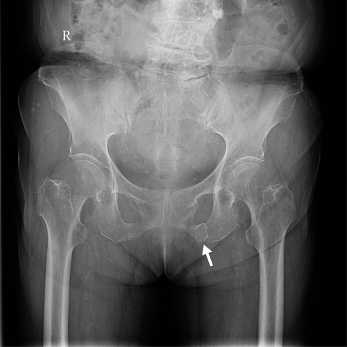 Figure 1. X-ray imaging of the pelvis confirmed the diagnosis of Van Neck–Odelberg disease, displaying characteristic changes in the ischial tuberosity (arrow).