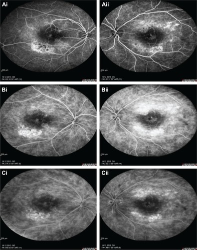 Figure 6 Represents the fundus fluorescein angiography of the right and left eye.