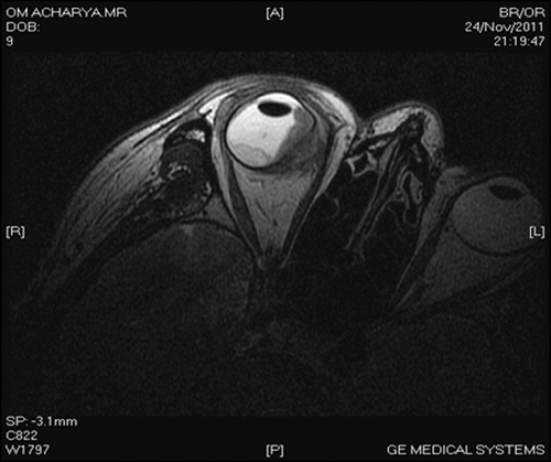 FIGURE 4  MRI surface coil T2 showing scleral perforation and necrosis and an overlying enhancing lesion in the right globe.