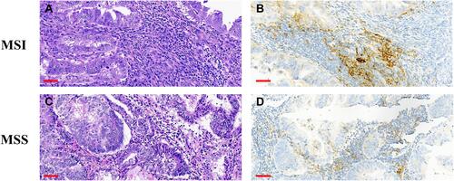 Figure 4 Upregulation of PD-L1 in MSI-H EC. (A–D) H&E staining and positive membrane staining for PD-L1 in MSI-H ECs. Scale bars: 60 μm.