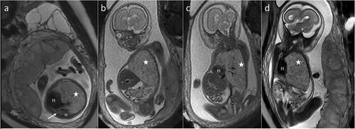 Figure 3. Fetal MRI performed at 29 gestational weeks. T2-Weighted images in axial (a), coronal – oblique (b, c) and sagittal oblique (d) planes. Enlarged left lung (*) compressing the fetal heart (H) and displacing it to the right side. Vestigial right lung (arrow). Free fluid in the abdomen.