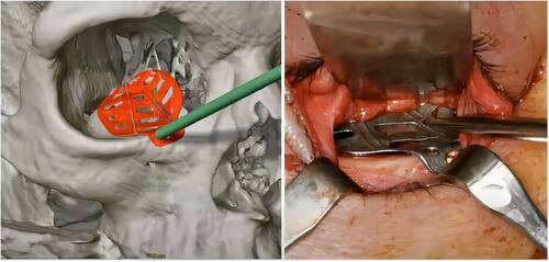 Figure 4 Pre-operative verification of orbital mesh (left) using navigation. Reproducing the plan during surgery under the guidance of navigation (right).