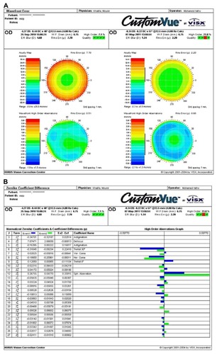 Figure 8 CustomVue™ software (Abbott Medical Optics Inc, Santa Ana, CA) showing the aberrometric outcomes in one patient that presented an improvement/ maintenance of HOA. (A) Shows wave-front maps, and (B) shows Zernike polynomials differences.