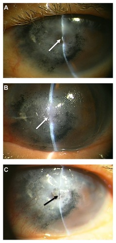 Figure 2 Patient 2, an 82-year-old woman. Preoperatively, corneal perforation with descemetocele (white arrow) was seen in the inferior paracentral area (A). The patient had received corneal tattooing approximately 40 years previously. Postoperatively, the perforation site was covered with glue and a hydrogel contact lens (white arrow) (B). Nineteen days later, the perforated site (black arrow) was closed (C).
