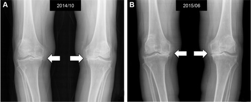 Figure 1 Standard weight-bearing knee X-rays of a 77-year-old female before (A) and 8 months after (B) one course of intra-articular PRP in association with HA injection, showing the increase in medial joint space (white arrows).