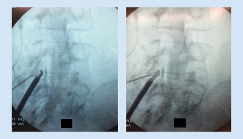 Figure 6. Images demonstrating a deployed bone rongeur (A) and tissue sculptor (B) between the lamina and within the epidural space.
