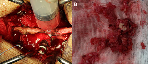 Figure 4 Intraoperative purulent fluid is seen during revision surgery (A). Disc tissue and little bone cement from L3/4 and L4/5 levels were collected during revision surgery (B).