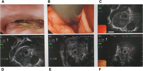 Figure 3 The images of ultrasound gastroscopy. (A) Esophageal tumor. (B) Cardia tumor. (C) Esophageal hypoechoic mass. (D) Swollen and hypoechoic lymph nodes beside esophagus. (E) Hypoechoic mass in abdominal cavity. (F) Multiple swollen and hypoechoic lymph nodes in retroperitoneum.