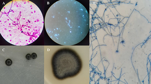 Figure 1 (A) Microscopic observation of the cerebral abscess specimen by Gram staining (Original magnification × 1000). (B) Microscopic observation of the cerebral abscess specimen by Fluorescent staining (Original magnification × 400). (C) The Macroscopic appearance of colonies on solid PDA media for 7 days at 35 °C. (D) The Macroscopic appearance of colonies on solid PDA media for 14 days at 35 °C. (E) Fungal morphology stained with medan lactate (Original magnification × 400).