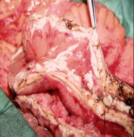 Figure 1 Healed mucosa but still thickened intestinal wall in patient previously submitted to intravenous infusion of infliximab. A strictureplasy is performed due to persisting obstructive symptoms.